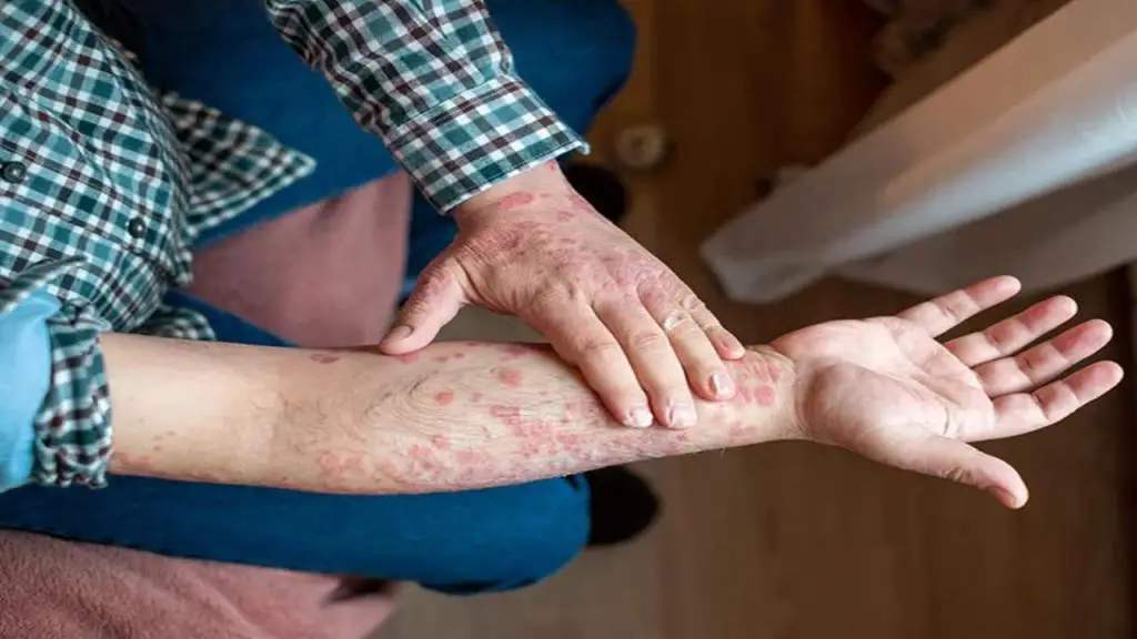 skin allergy